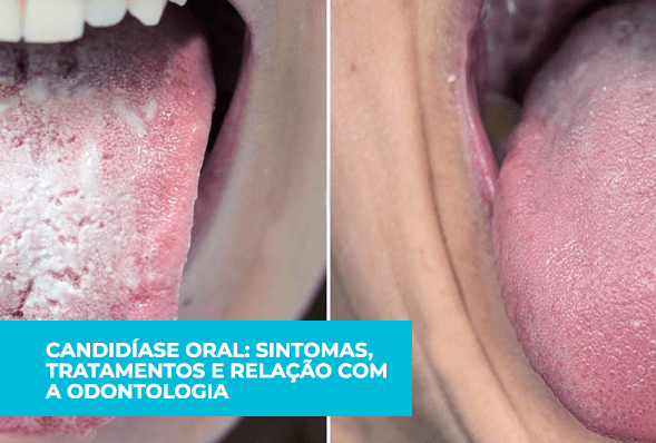 Candidíase oral: sintomas, tratamentos e relação com a Odontologia