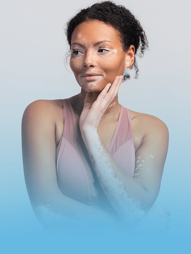 Tratamento para vitiligo e outras condições: despigmentação da pele