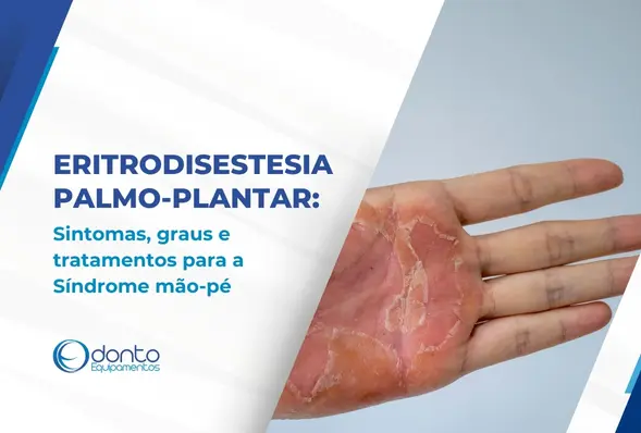 Eritrodisestesia Palmo-Plantar: sintomas, graus e tratamentos para a Síndrome mão-pé