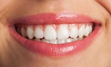 ilustração - clareamento dental em consultório